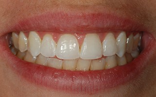 Closeup of After Teeth Bleaching