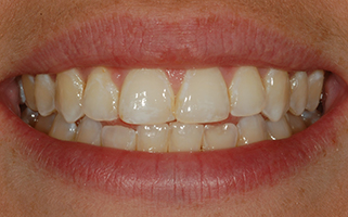 Closeup of Before Teeth Bleaching