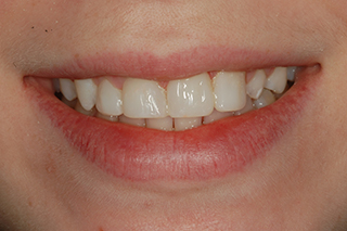 After picture of bonding to correct a missing lateral incisor