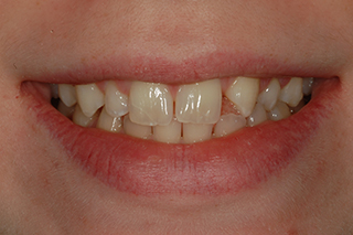 Before picture of bonding to correct a missing lateral incisor