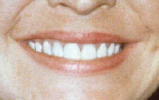 Closeup After Picture of Teeth Stained by the Antibiotic Tetracycline Whitened by Bonding