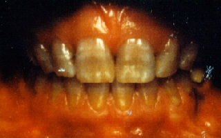 Before Picture of Teeth Stained by the Antibiotic Tetracycline