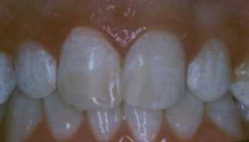 After Picture of Discolored Front Teeth Whitened by Bonding
