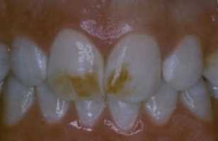 Before Picture of Discolored Front Teeth