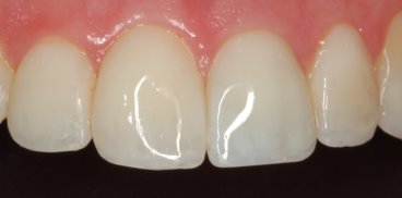 Closeup of Teeth With Flurosis After Bonding