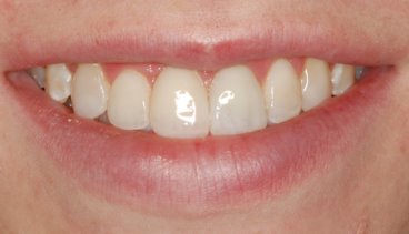 Smile of Teeth With Flurosis After Dental Bonding