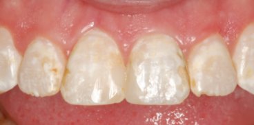 Closeup of Teeth With Flurosis Before Bonding
