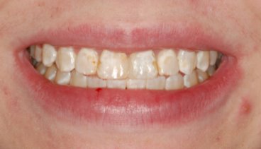 Smile of Teeth With Flurosis Before Bonding