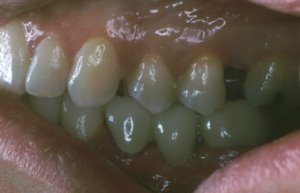Left Side Dental Bridges to Replace Missing Teeth