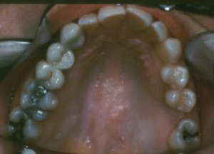 Dental Bridge on Upper Arch to Replace Missing Teeth