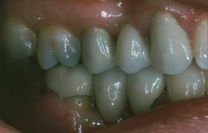 Right Side Dental Bridges to Replace Missing Teeth