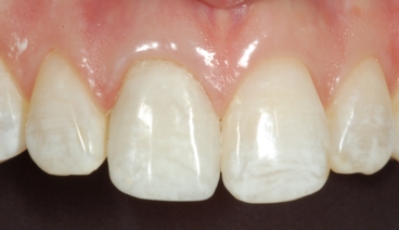 Closeup of a Discolored Tooth Corrected With a Crown