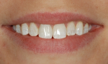 Discolored Tooth Corrected With a Crown 