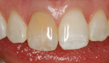 Closeup of a Discolored Tooth Corrected With a Crown