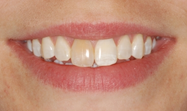 Discolored Tooth Corrected With a Crown