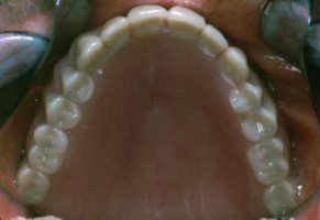 Palatal view of upper denture in place