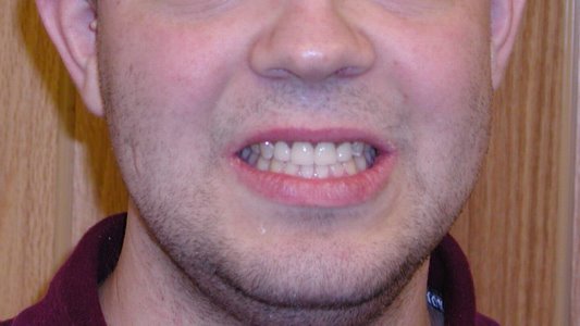 An impressive smile once teeth erosion was repaired with porcelain crowns