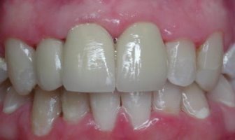 Teeth have been restored with porcelain crowns
