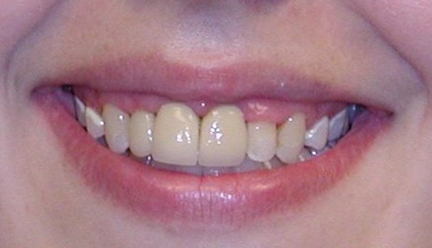 A much improved smile now that the decay is removed and the front teeth are restored with porcelain crowns