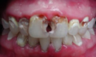 A large amount of tooth decay closeup