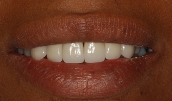 Teeth erosion repaired with porcelain crowns