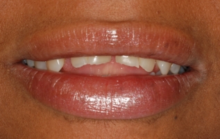 Teeth erosion damage