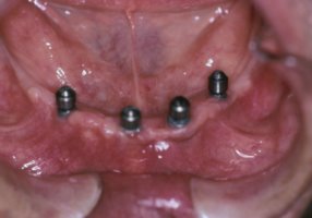 Dental implants after healing