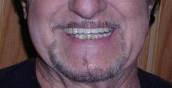 Closeup smile of a very happy patient with his new bridge affixed to dental implants