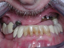 Front view of healed dental implants are now ready to be restored