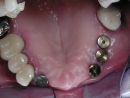Healed dental implants are now ready to be restored