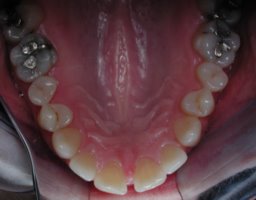 Close gap with invisible braces before upper view