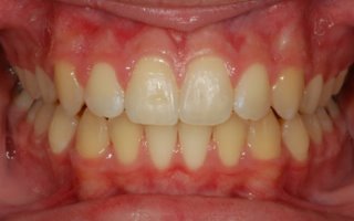 Overbite correction with a retainer front teeth after