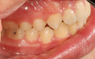 Overbite correction with retainer right after
