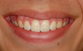 Overbite correction with retainer after smile
