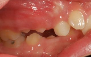 Overbite correction with retainer right before