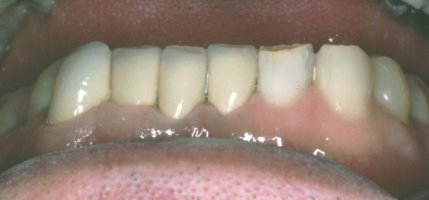 Crowns were placed to cover severely worn teeth without the need for root canal treatment