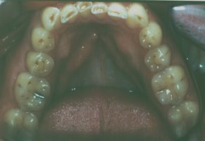 Before picture of severely worn teeth