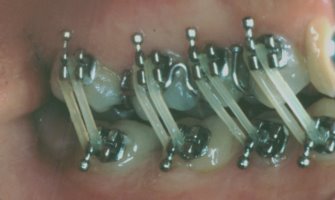 Braces are used to open this patient's bite to make room for crowns