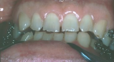 Braces are used to open this patient's bite to make room for crowns