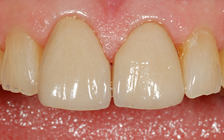 Teeth gap restored with porcelain laminates 25 years later