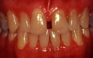 Gap in front teeth