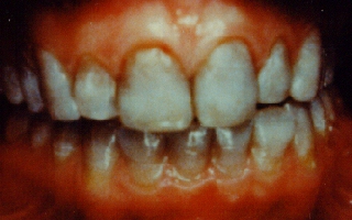 Teeth stain from tetracycline
