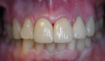 Chipped teeth after being restored with porcelain laminates