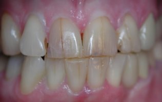 Chipped teeth before being restored with porcelain laminates