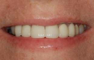 Teeth after porcelain laminates and dental bridges