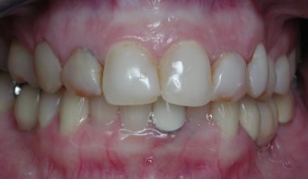 Teeth before porcelain laminates and dental bridges