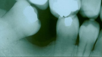 X-ray of teeth before orthodontic uprighting