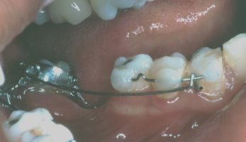 Teeth during orthodontic uprighting