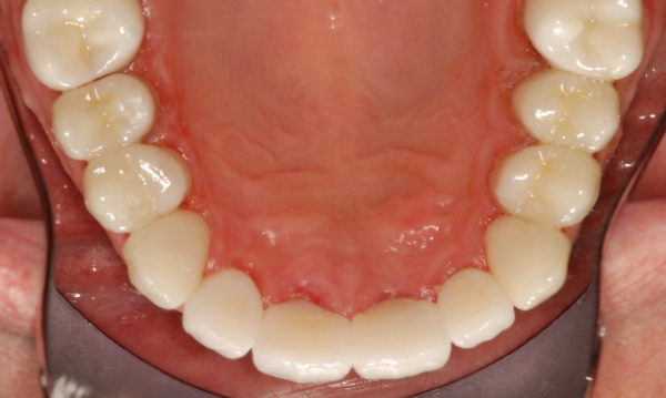 Full Mouth Reconstruction Has Restored This Patient to Full Function After Grinding His Teeth