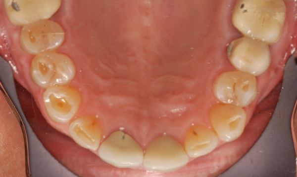 Upper View of an Extremely Worn Teeth from Teeth Grinding